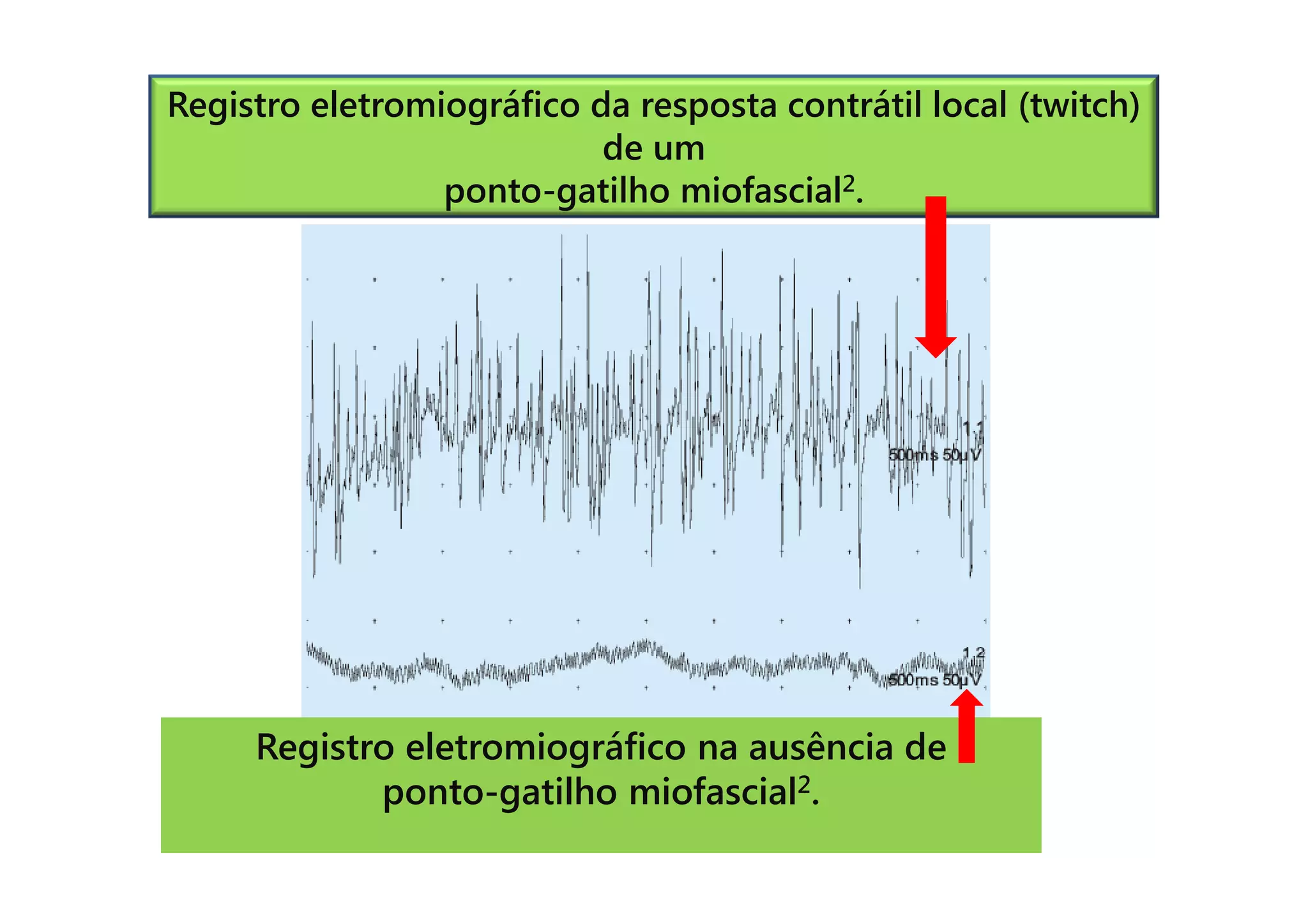 Registro eletromiográfico da resposta contrátil local (twitch)
de um
ponto-gatilho miofascial2.
Registro eletromiográfico na ausência de
ponto-gatilho miofascial2.
 