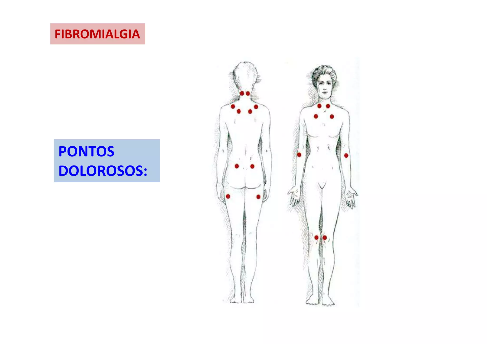 FIBROMIALGIA
PONTOS
DOLOROSOS:
 