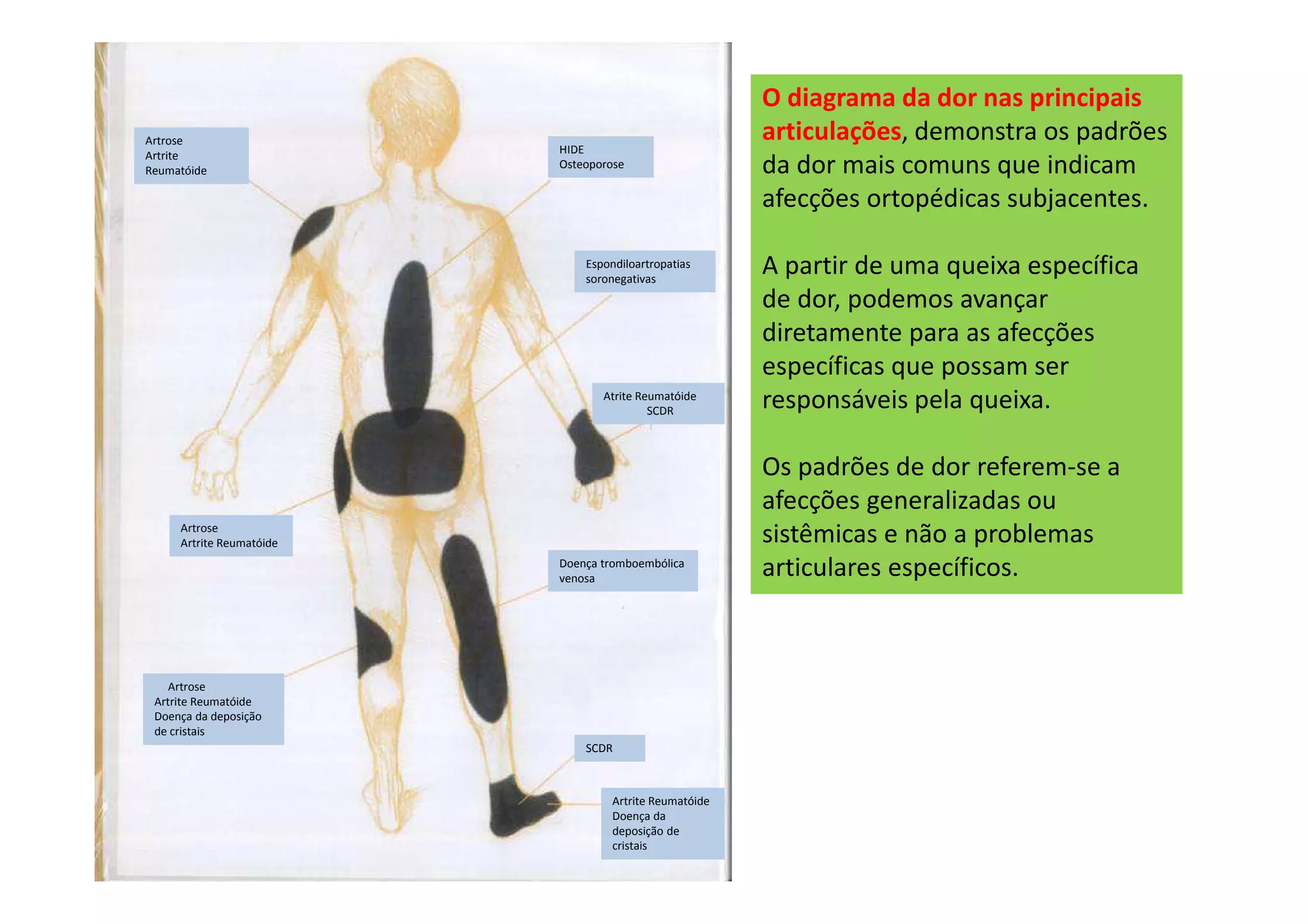 O diagrama da dor nas principais
articulações, demonstra os padrões
da dor mais comuns que indicam
afecções ortopédicas subjacentes.
A partir de uma queixa específica
de dor, podemos avançar
diretamente para as afecções
específicas que possam ser
responsáveis pela queixa.
Os padrões de dor referem-se a
afecções generalizadas ou
sistêmicas e não a problemas
articulares específicos.
Artrose
Artrite
Reumatóide
HIDE
Osteoporose
Espondiloartropatias
soronegativas
Atrite Reumatóide
SCDR
Artrose
Artrite Reumatóide
Artrose
Artrite Reumatóide
Doença da deposição
de cristais
Doença tromboembólica
venosa
SCDR
Artrite Reumatóide
Doença da
deposição de
cristais
 