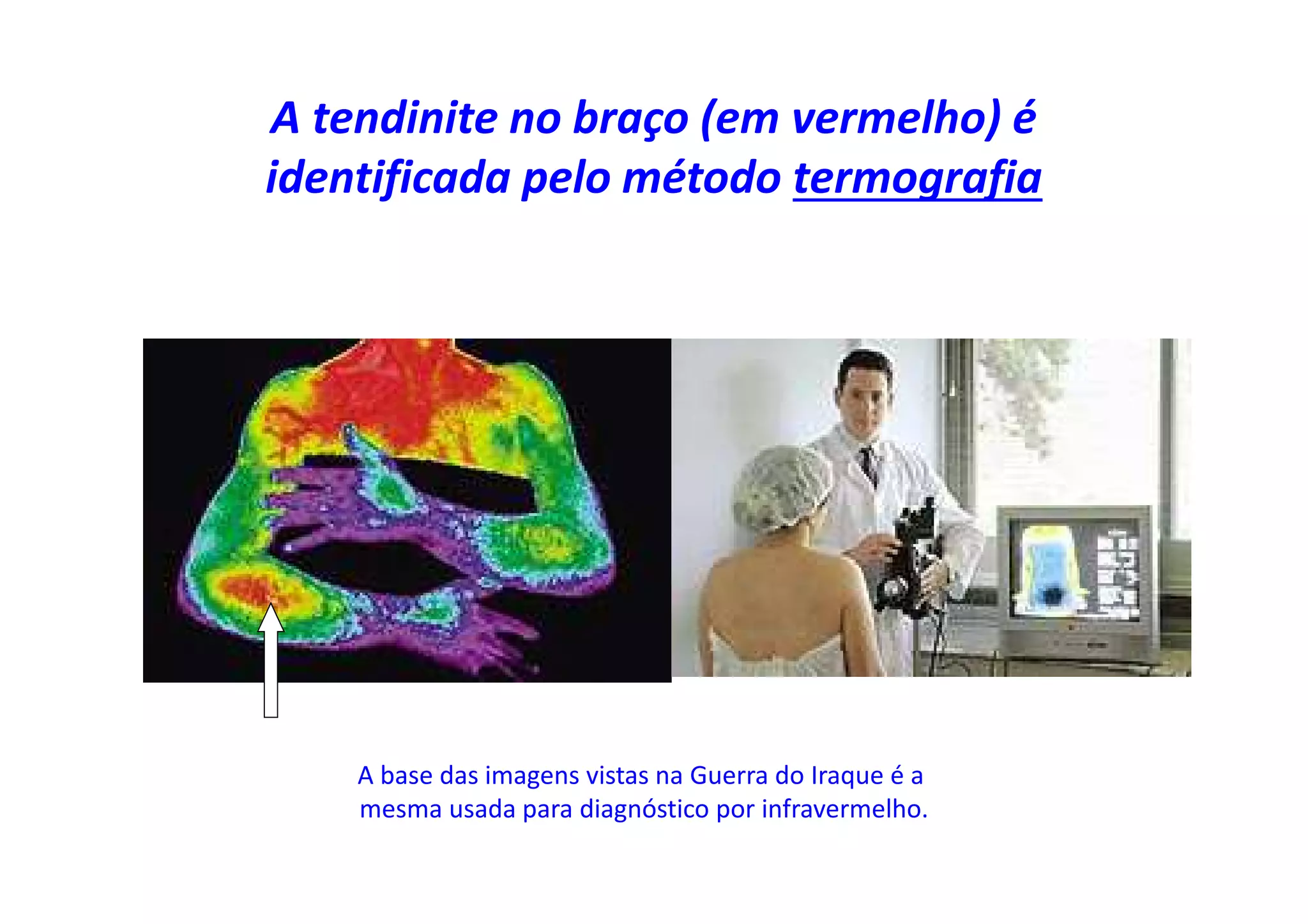 A tendinite no braço (em vermelho) é
identificada pelo método termografia
A base das imagens vistas na Guerra do Iraque é a
mesma usada para diagnóstico por infravermelho.
 