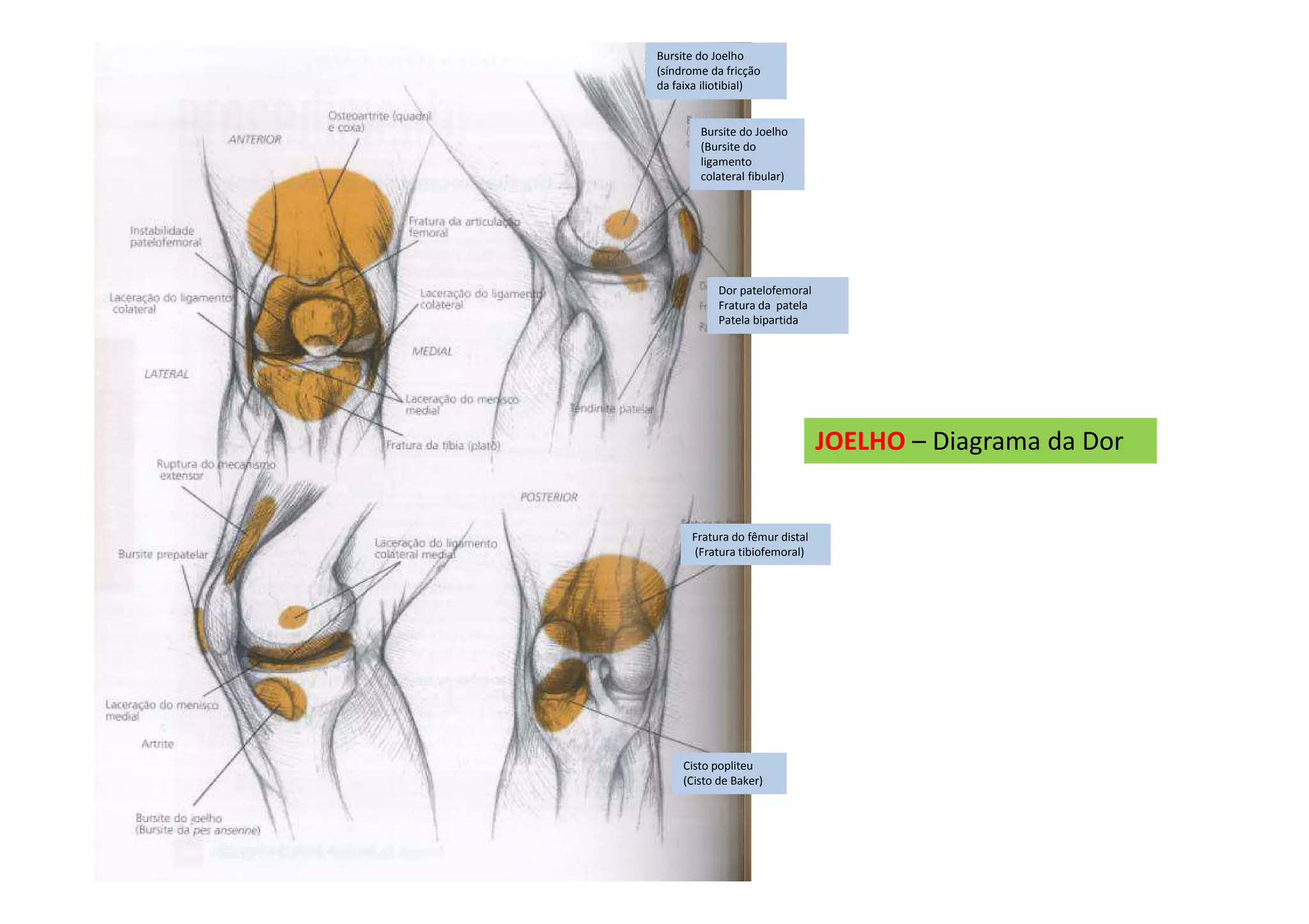 JOELHO – Diagrama da Dor
Bursite do Joelho
(síndrome da fricção
da faixa iliotibial)
Bursite do Joelho
(Bursite do
ligamento
colateral fibular)
Dor patelofemoral
Fratura da patela
Patela bipartida
Fratura do fêmur distal
(Fratura tibiofemoral)
Cisto popliteu
(Cisto de Baker)
 