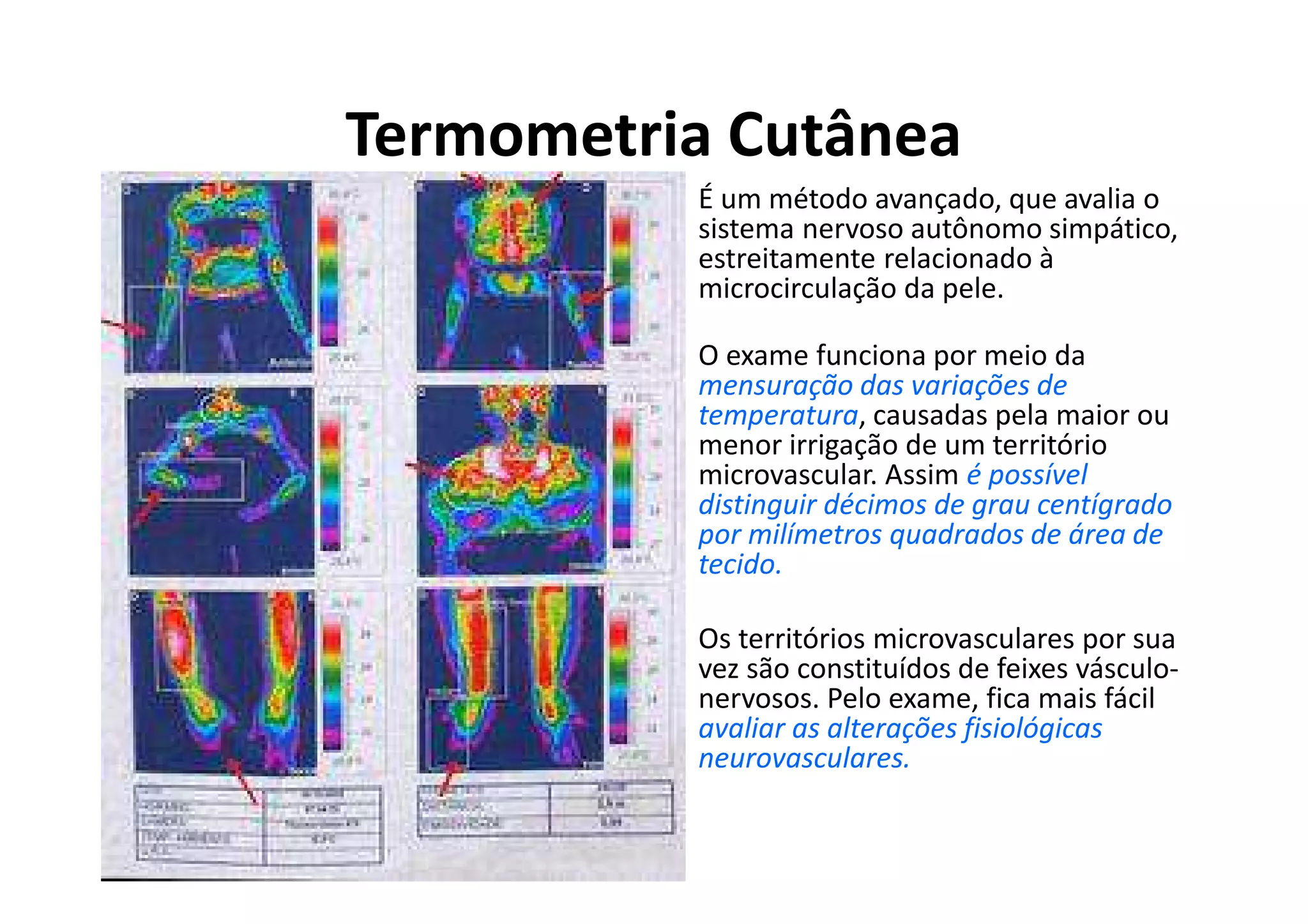 Termometria Cutânea
• É um método avançado, que avalia o
sistema nervoso autônomo simpático,
estreitamente relacionado à
microcirculação da pele.
• O exame funciona por meio da
mensuração das variações de
temperatura, causadas pela maior ou
menor irrigação de um território
microvascular. Assim é possível
distinguir décimos de grau centígrado
por milímetros quadrados de área de
tecido.
• Os territórios microvasculares por sua
vez são constituídos de feixes vásculo-
nervosos. Pelo exame, fica mais fácil
avaliar as alterações fisiológicas
neurovasculares.
 