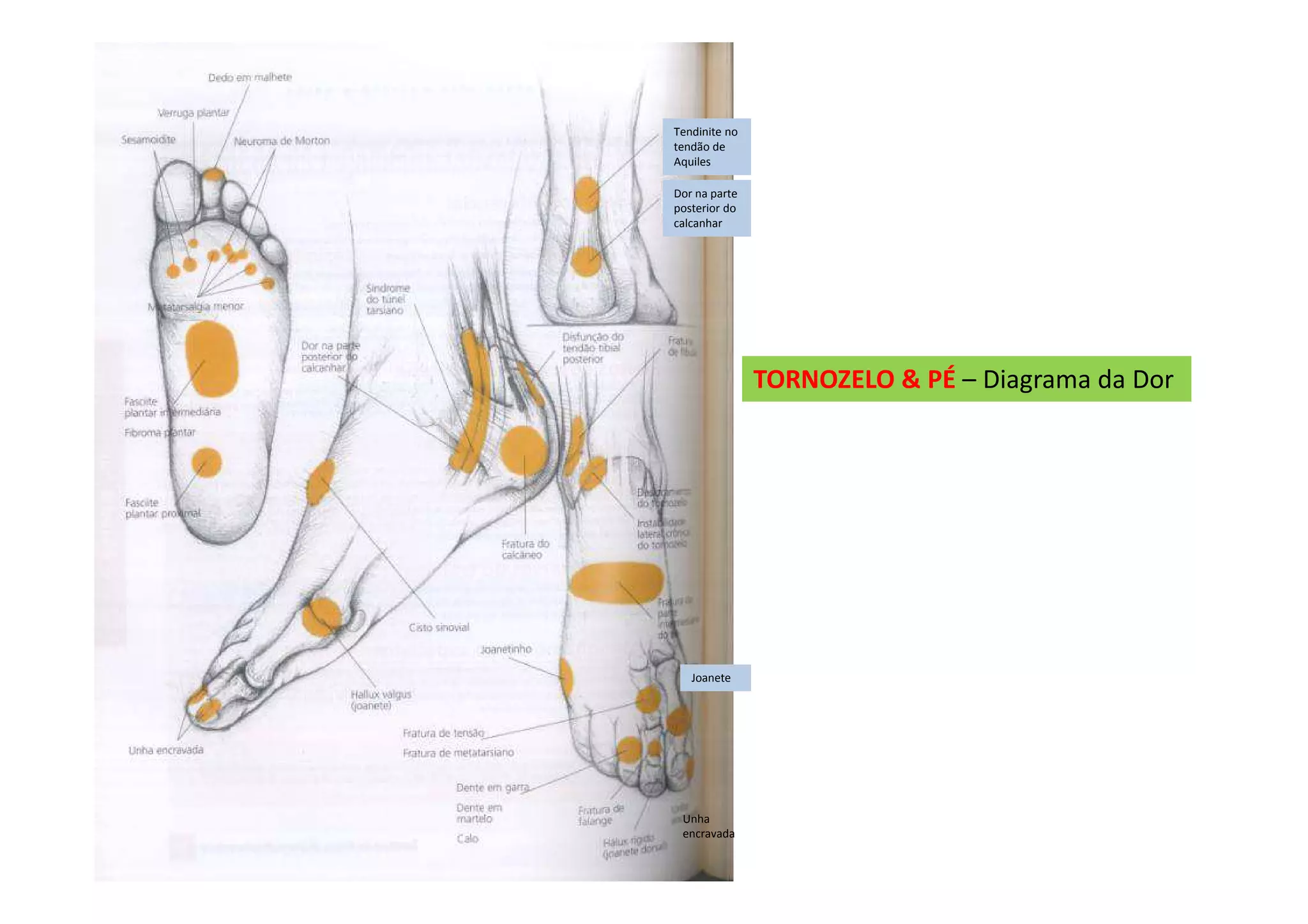 TORNOZELO & PÉ – Diagrama da Dor
Tendinite no
tendão de
Aquiles
Dor na parte
posterior do
calcanhar
Joanete
Unha
encravada
 