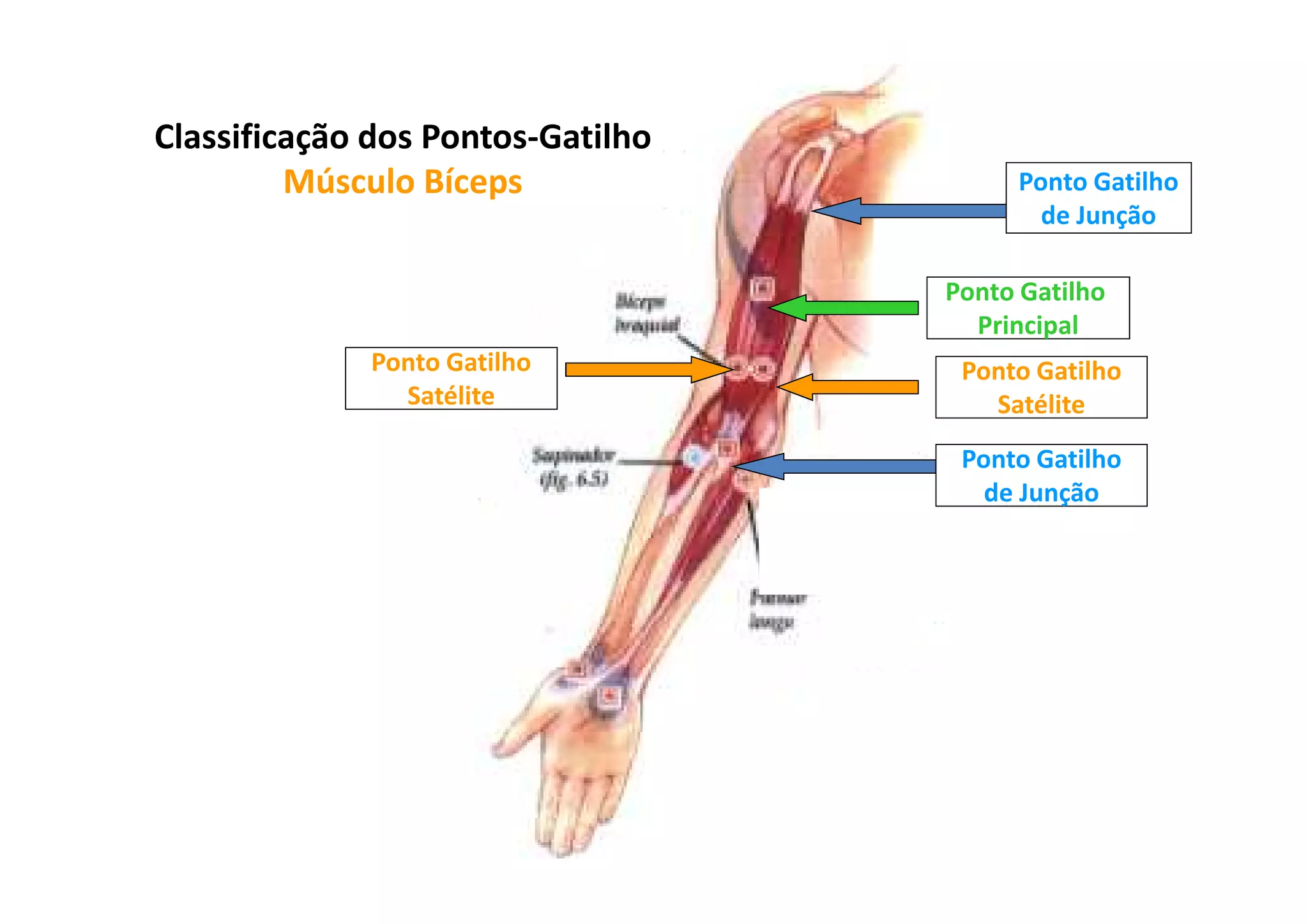 Ponto Gatilho
Principal
Ponto Gatilho
Satélite
Ponto Gatilho
Satélite
Ponto Gatilho
de Junção
Ponto Gatilho
de Junção
Classificação dos Pontos-Gatilho
Músculo Bíceps
 