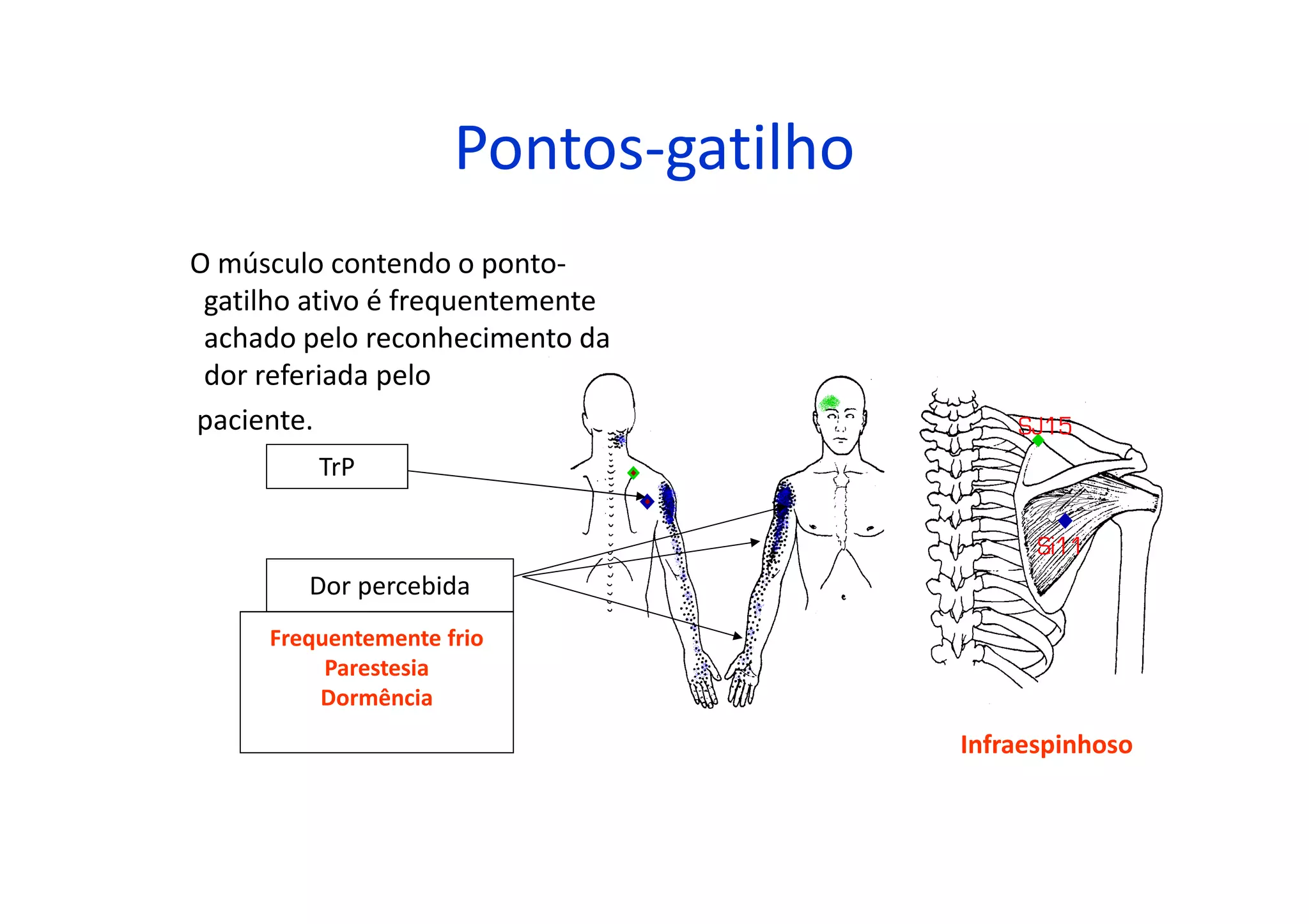 Pontos-gatilho
O músculo contendo o ponto-
gatilho ativo é frequentemente
achado pelo reconhecimento da
dor referiada pelo
paciente.
TrP
Dor percebida
Frequentemente frio
Parestesia
Dormência
Infraespinhoso
 