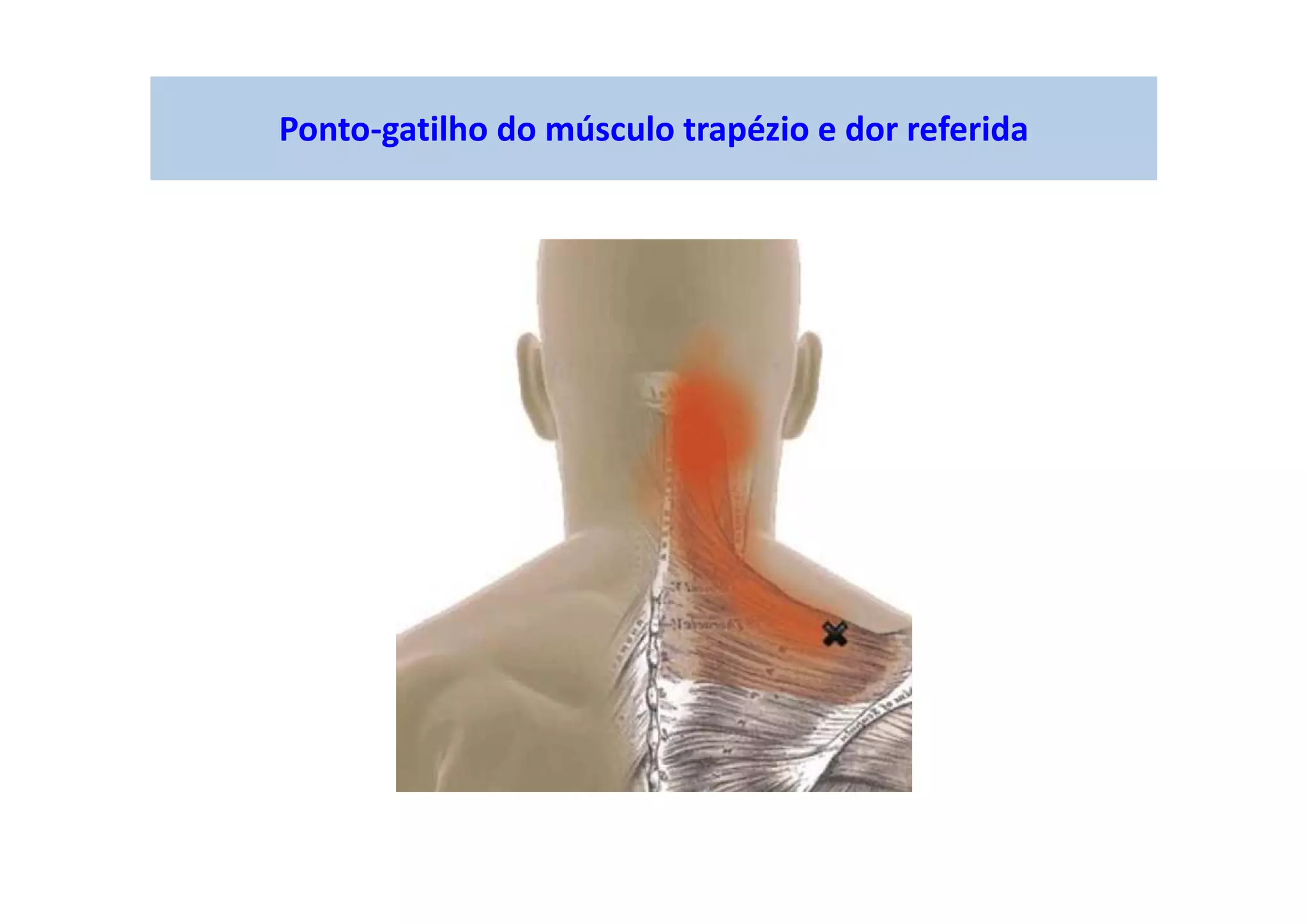 Ponto-gatilho do músculo trapézio e dor referida
 