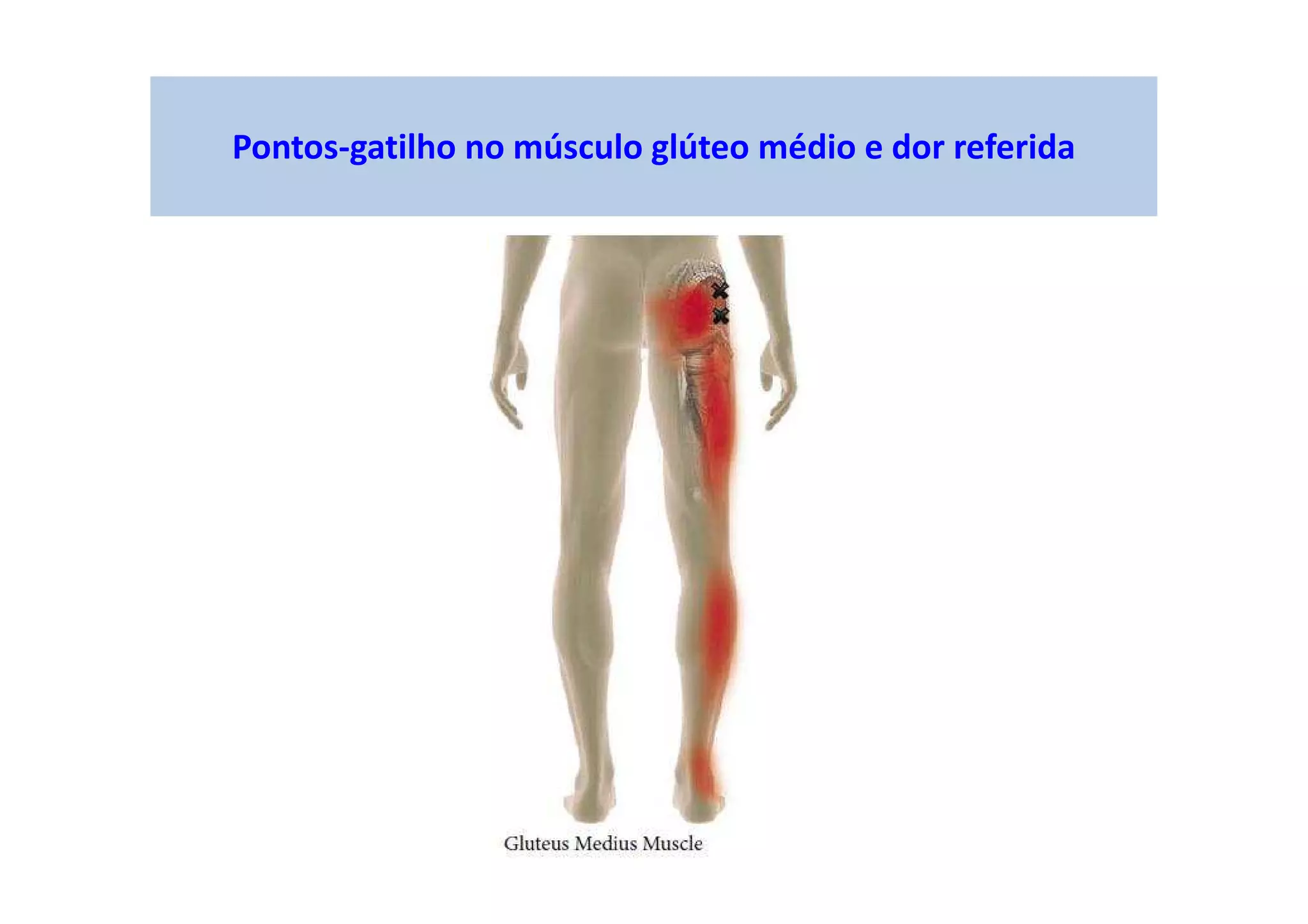 Pontos-gatilho no músculo glúteo médio e dor referida
 