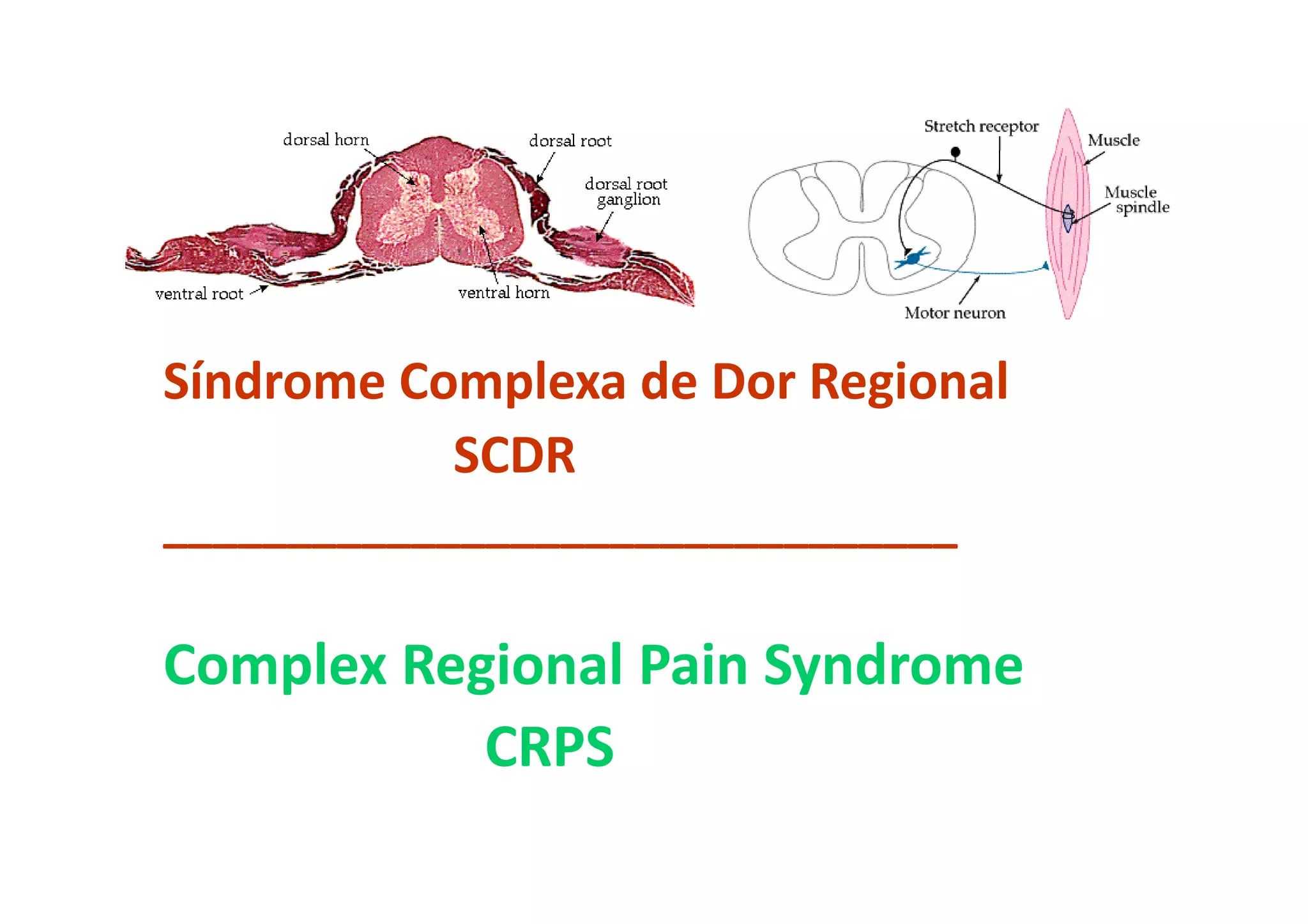 Síndrome Complexa de Dor Regional
SCDR
________________________________
Complex Regional Pain Syndrome
CRPS
 