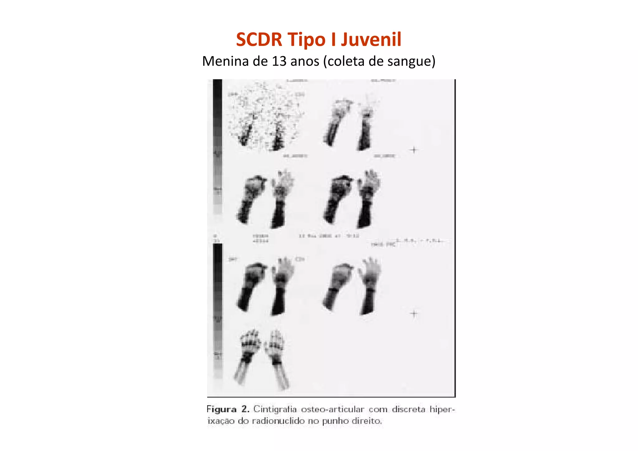 SCDR Tipo I Juvenil
Menina de 13 anos (coleta de sangue)
 