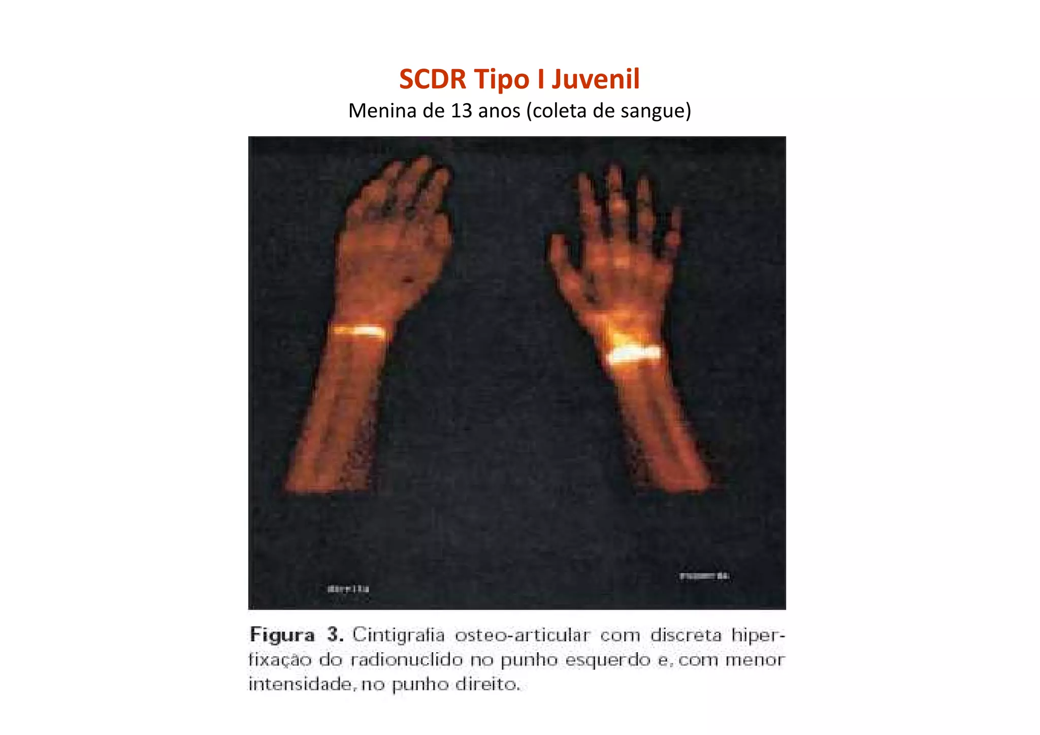 SCDR Tipo I Juvenil
Menina de 13 anos (coleta de sangue)
 