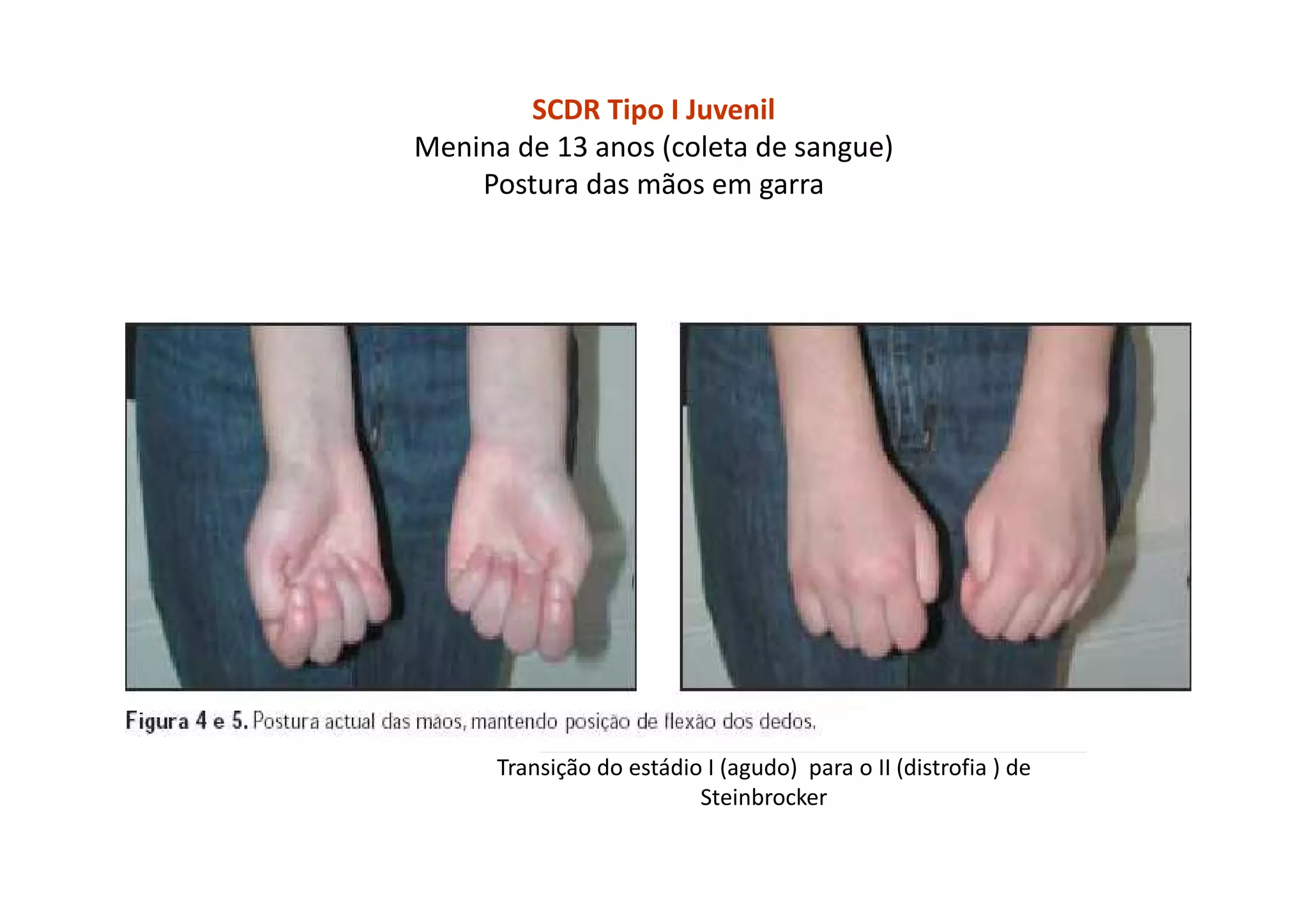 SCDR Tipo I Juvenil
Menina de 13 anos (coleta de sangue)
Postura das mãos em garra
Transição do estádio I (agudo) para o II (distrofia ) de
Steinbrocker
 
