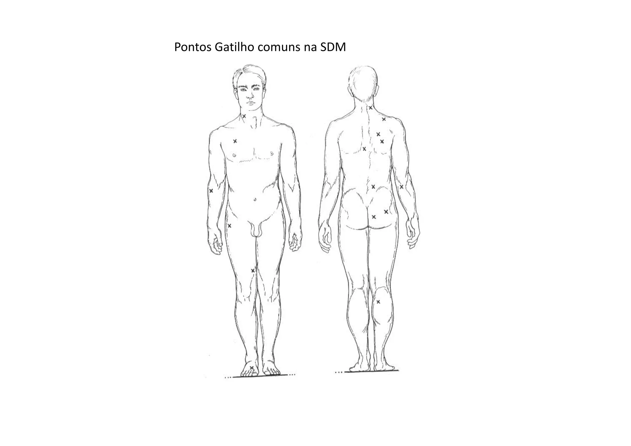 Pontos Gatilho comuns na SDM
 