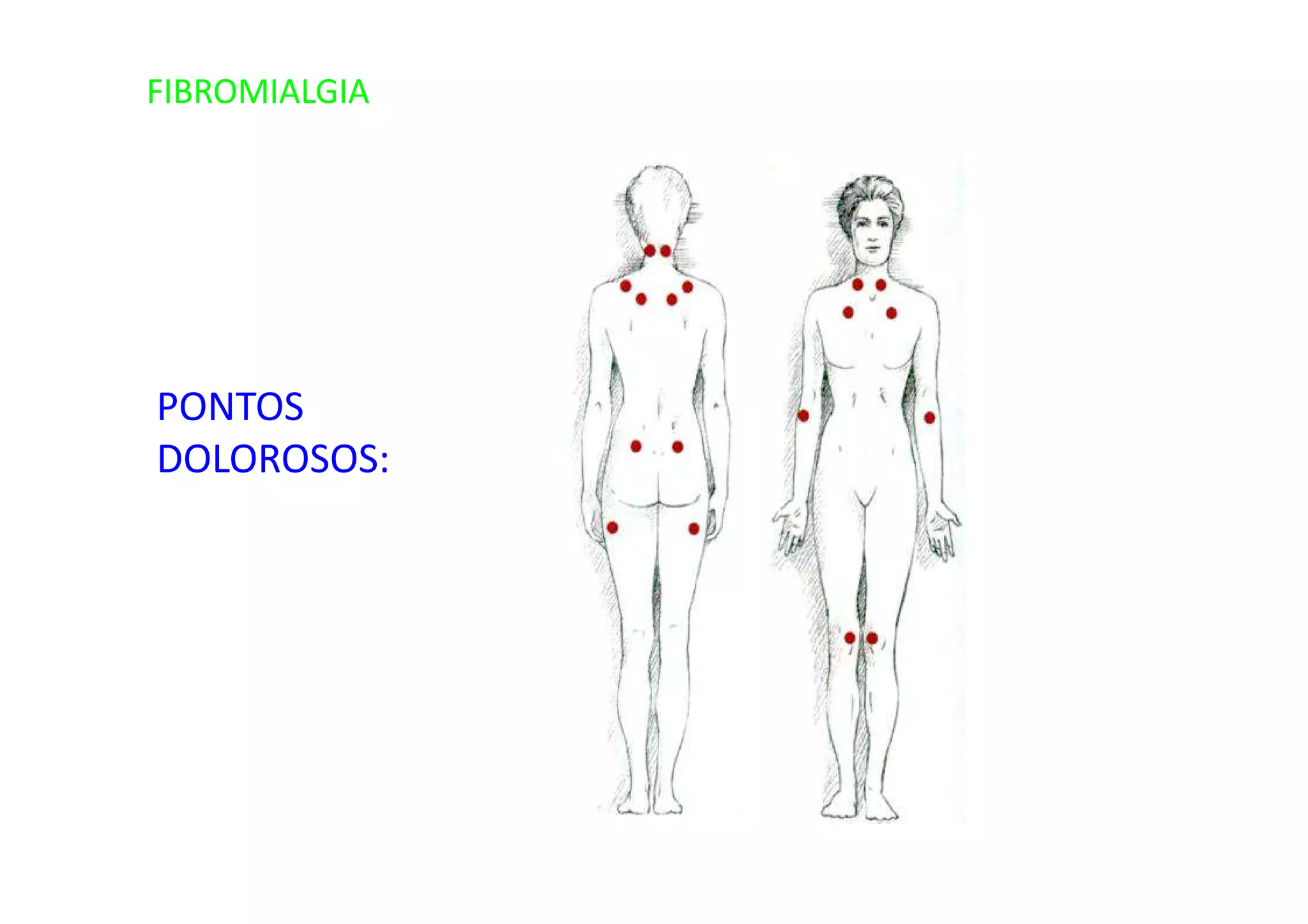 FIBROMIALGIA
PONTOS
DOLOROSOS:
 