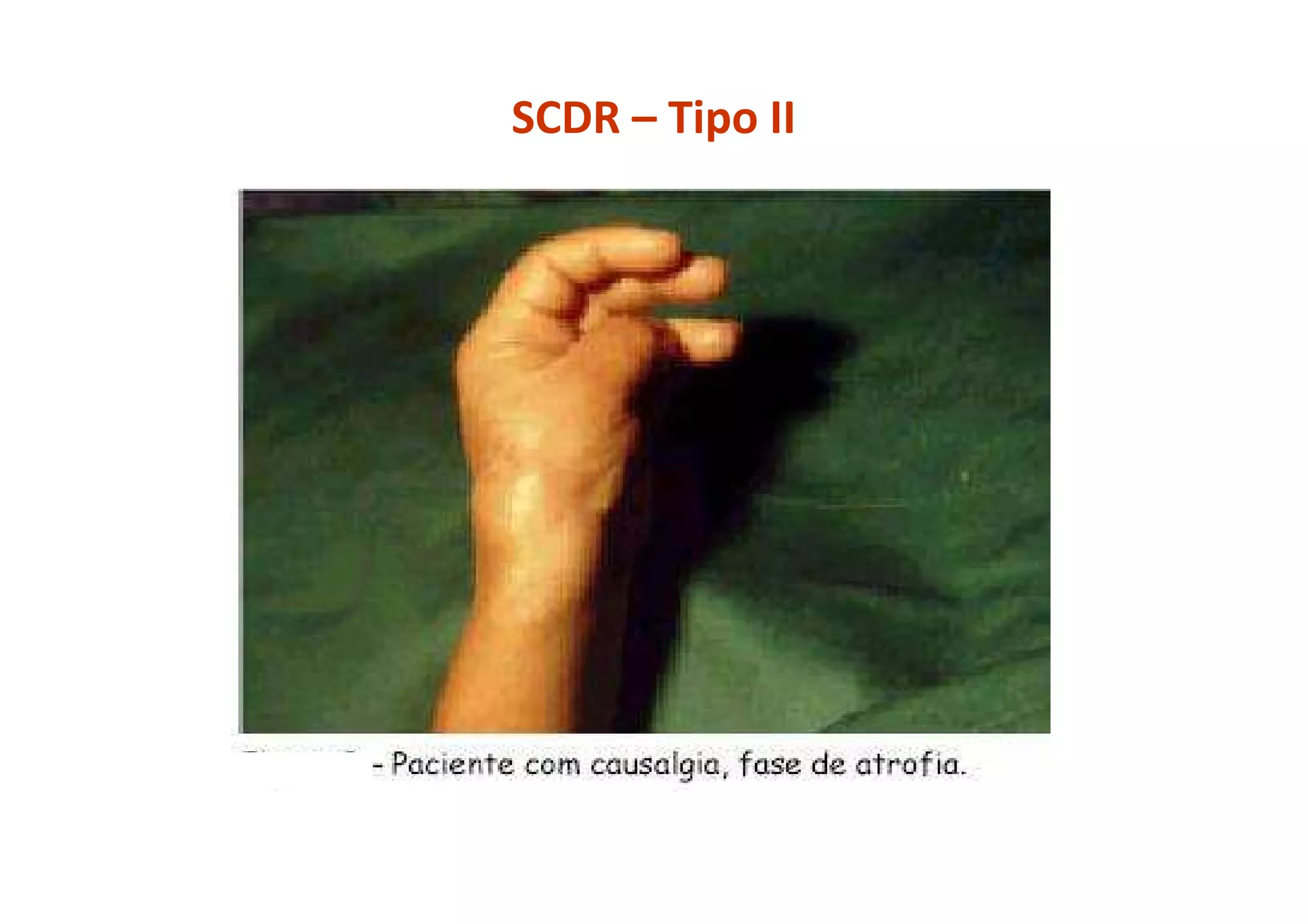 SCDR – Tipo II
 