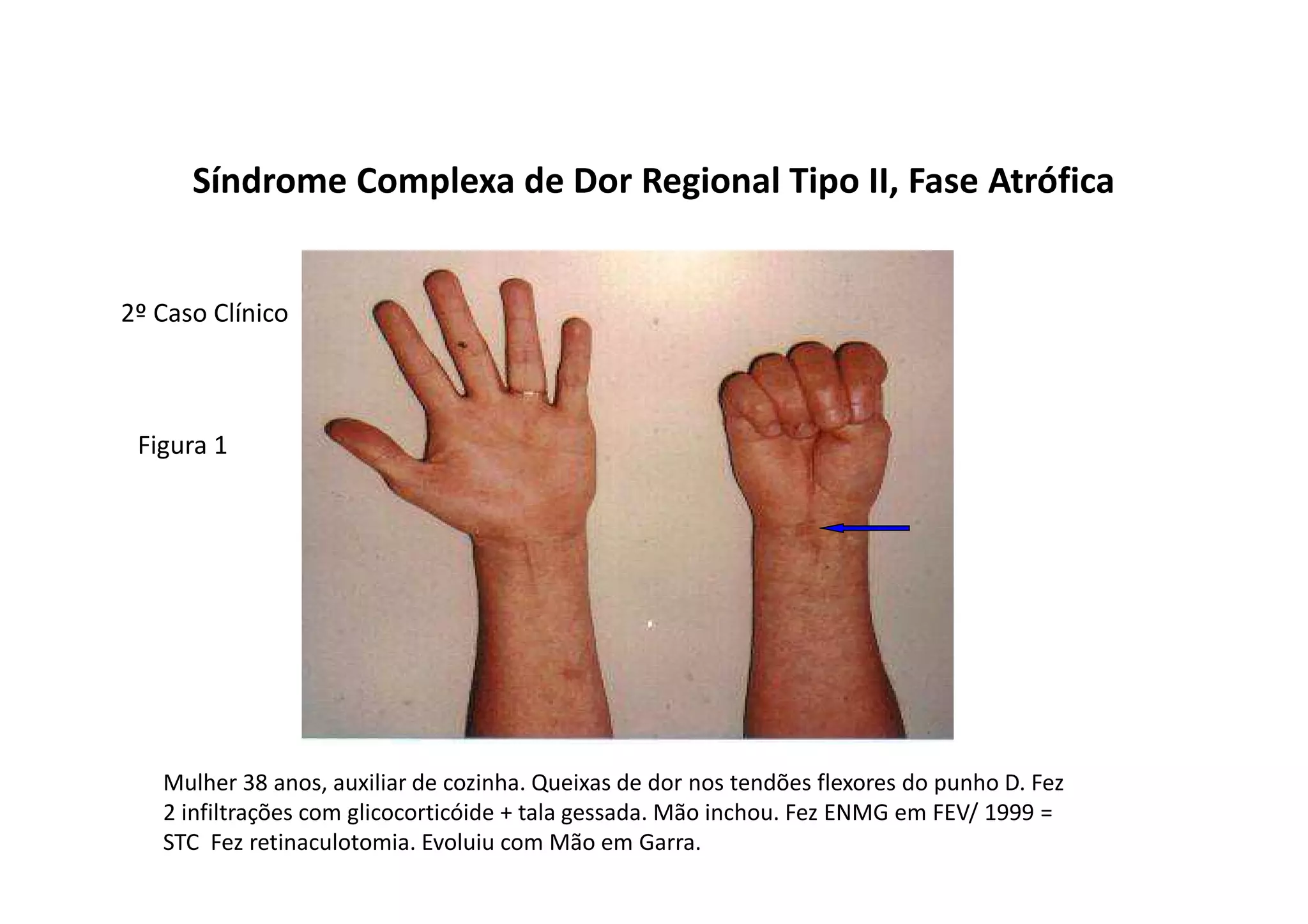 Síndrome Complexa de Dor Regional Tipo II, Fase Atrófica
Figura 1
Mulher 38 anos, auxiliar de cozinha. Queixas de dor nos tendões flexores do punho D. Fez
2 infiltrações com glicocorticóide + tala gessada. Mão inchou. Fez ENMG em FEV/ 1999 =
STC Fez retinaculotomia. Evoluiu com Mão em Garra.
2º Caso Clínico
 
