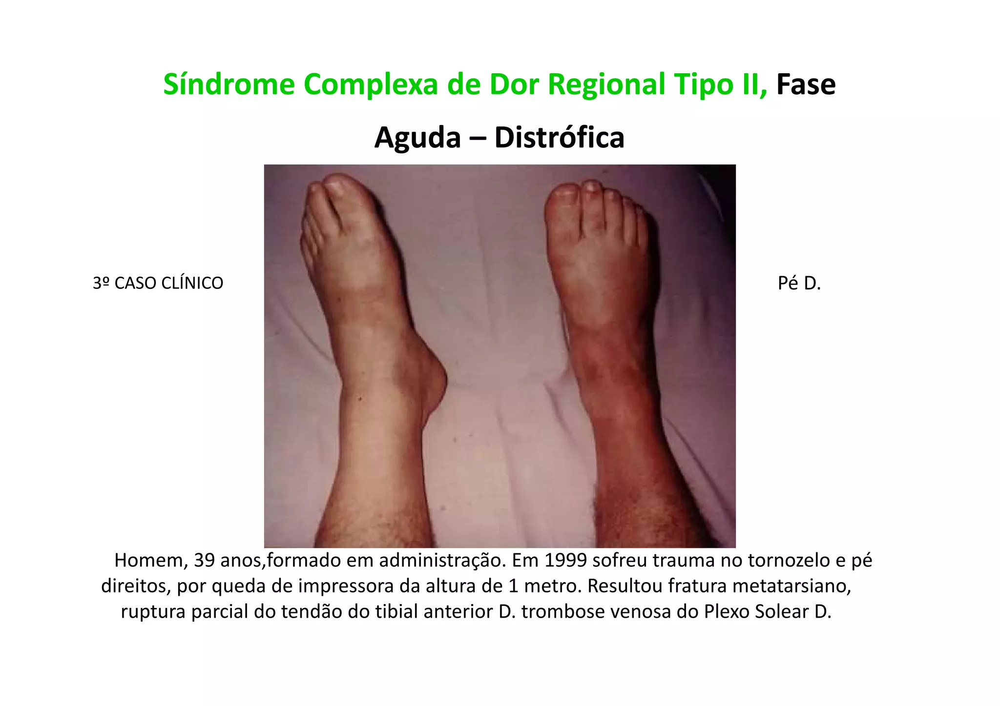 Síndrome Complexa de Dor Regional Tipo II, Fase
Aguda – Distrófica
3º CASO CLÍNICO
Homem, 39 anos,formado em administração. Em 1999 sofreu trauma no tornozelo e pé
direitos, por queda de impressora da altura de 1 metro. Resultou fratura metatarsiano,
ruptura parcial do tendão do tibial anterior D. trombose venosa do Plexo Solear D.
Pé D.
 