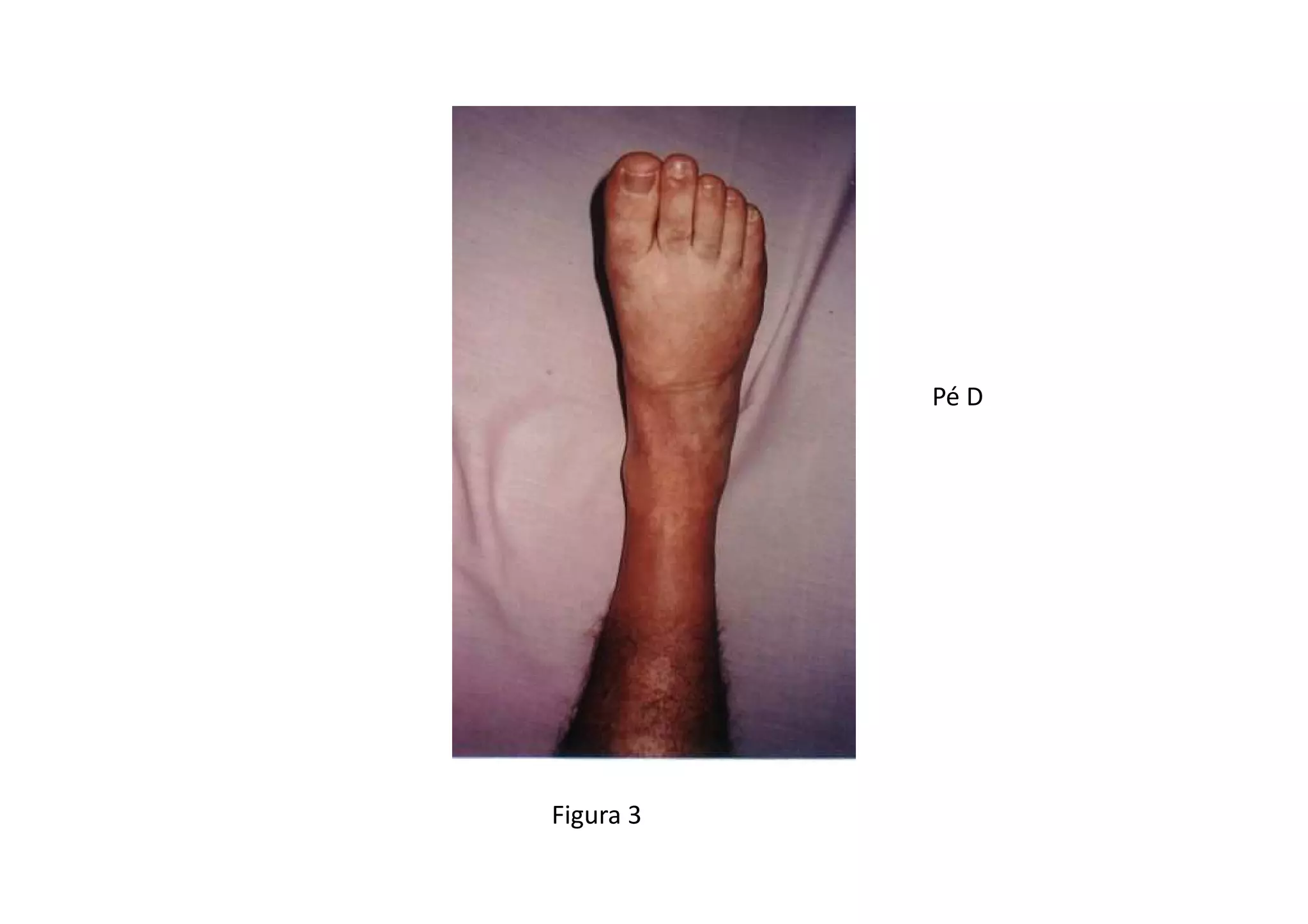 Figura 3
Pé D
 