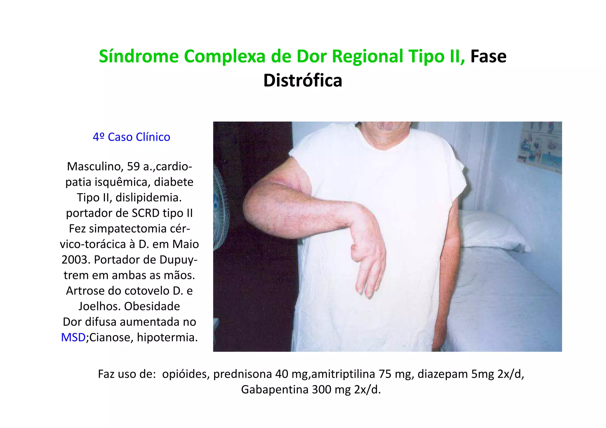 Síndrome Complexa de Dor Regional Tipo II, Fase
Distrófica
4º Caso Clínico
Masculino, 59 a.,cardio-
patia isquêmica, diabete
Tipo II, dislipidemia.
portador de SCRD tipo II
Fez simpatectomia cér-
vico-torácica à D. em Maio
2003. Portador de Dupuy-
trem em ambas as mãos.
Artrose do cotovelo D. e
Joelhos. Obesidade
Dor difusa aumentada no
MSD;Cianose, hipotermia.
Faz uso de: opióides, prednisona 40 mg,amitriptilina 75 mg, diazepam 5mg 2x/d,
Gabapentina 300 mg 2x/d.
 