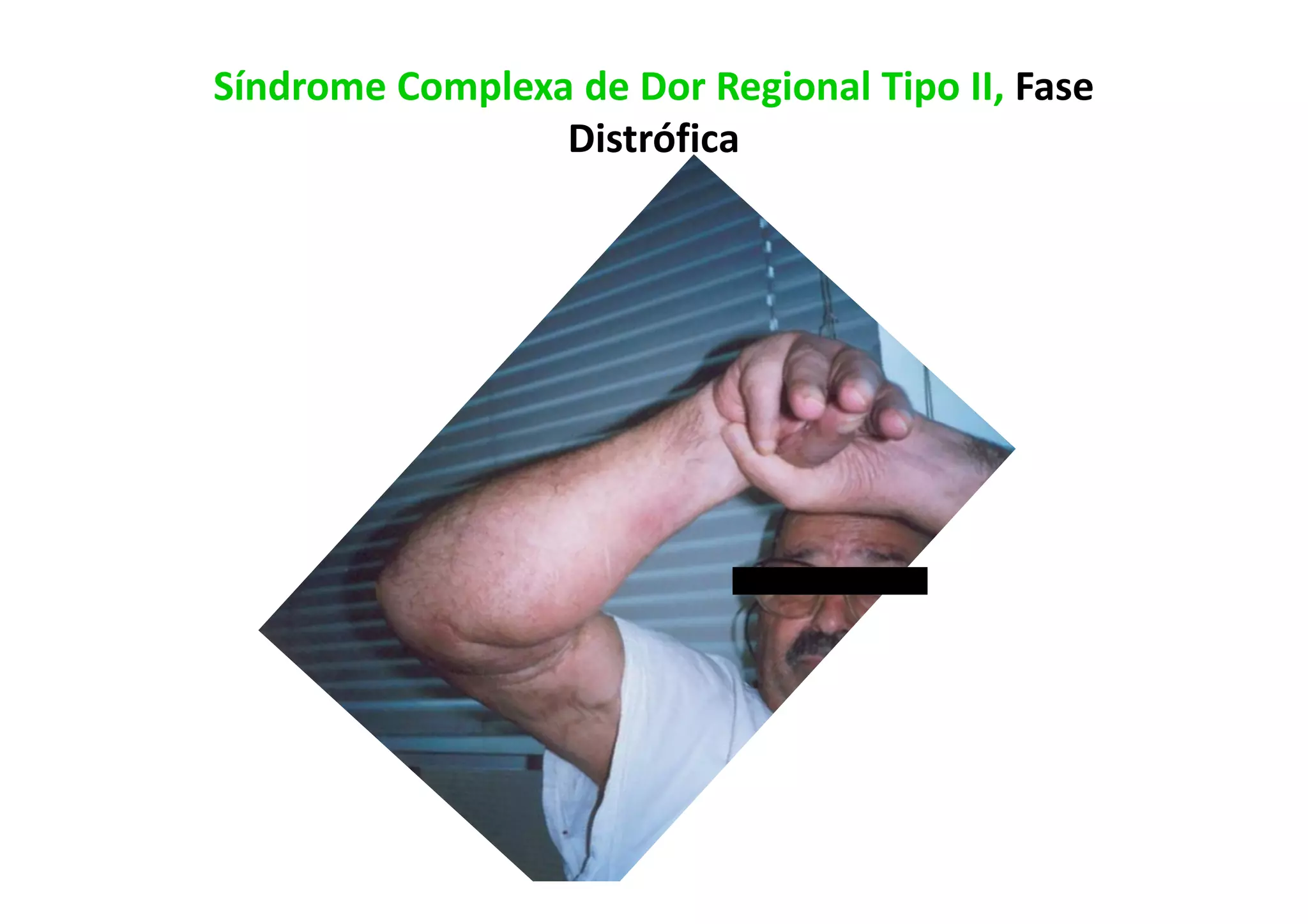 Síndrome Complexa de Dor Regional Tipo II, Fase
Distrófica
 