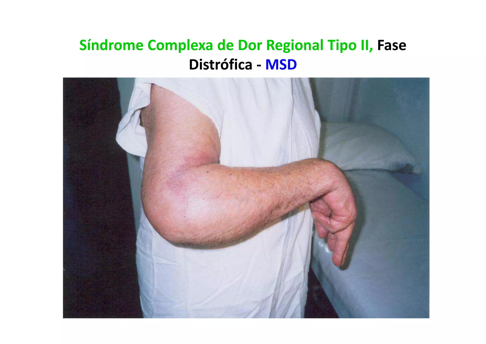 Síndrome Complexa de Dor Regional Tipo II, Fase
Distrófica - MSD
 
