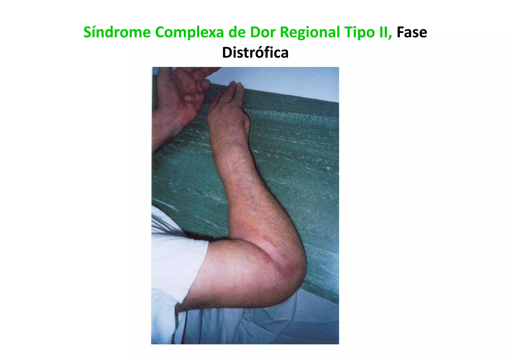 Síndrome Complexa de Dor Regional Tipo II, Fase
Distrófica
 