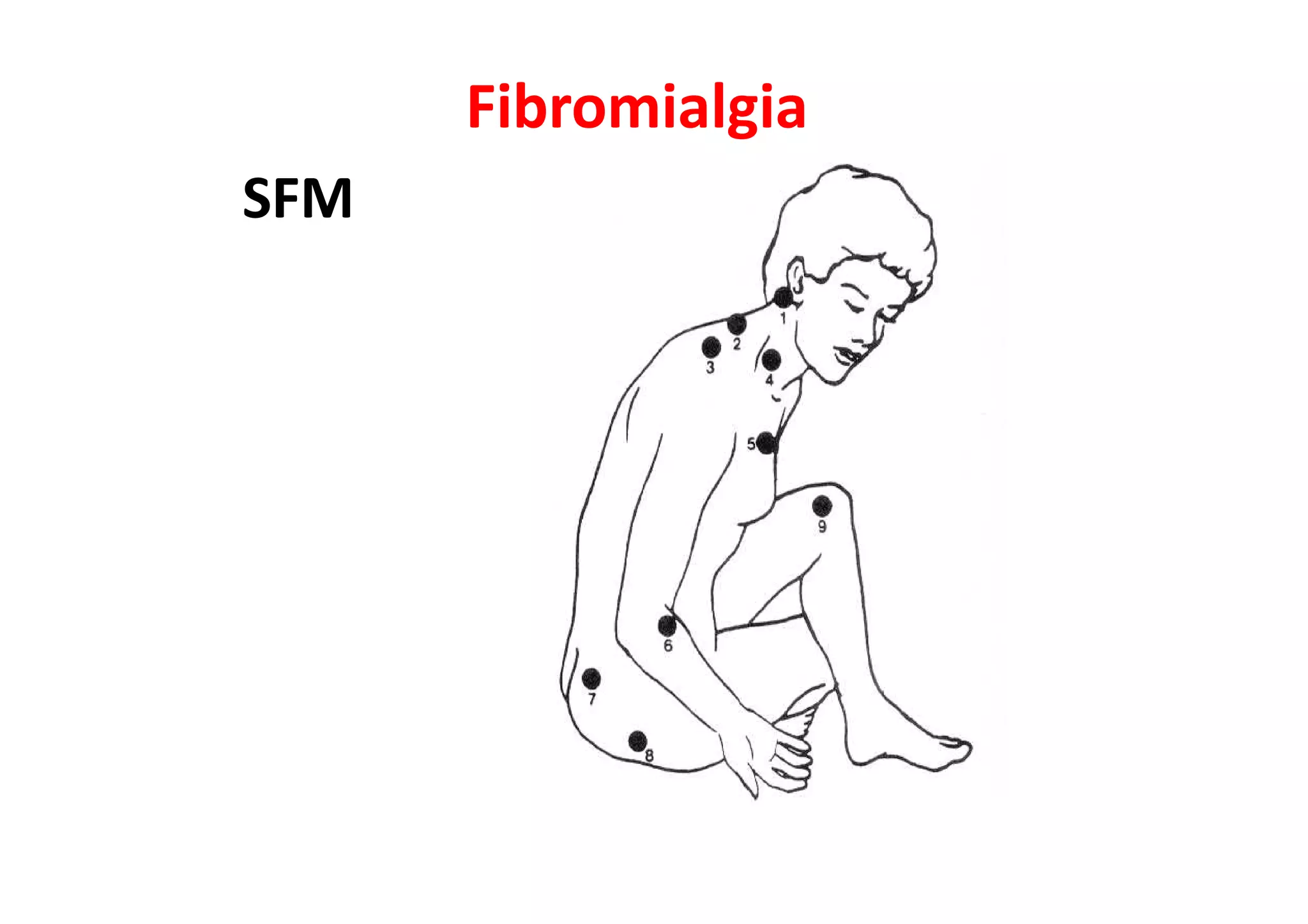 Fibromialgia
SFM
 