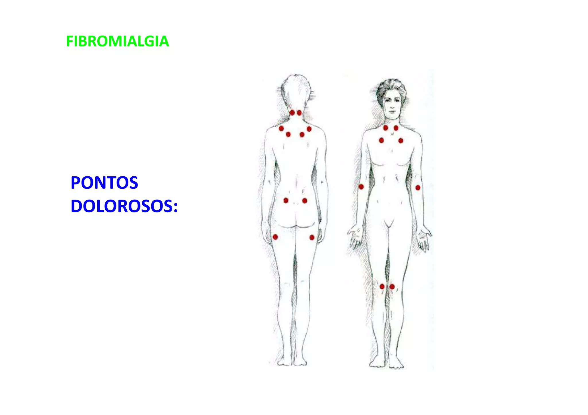 FIBROMIALGIA
PONTOS
DOLOROSOS:
 
