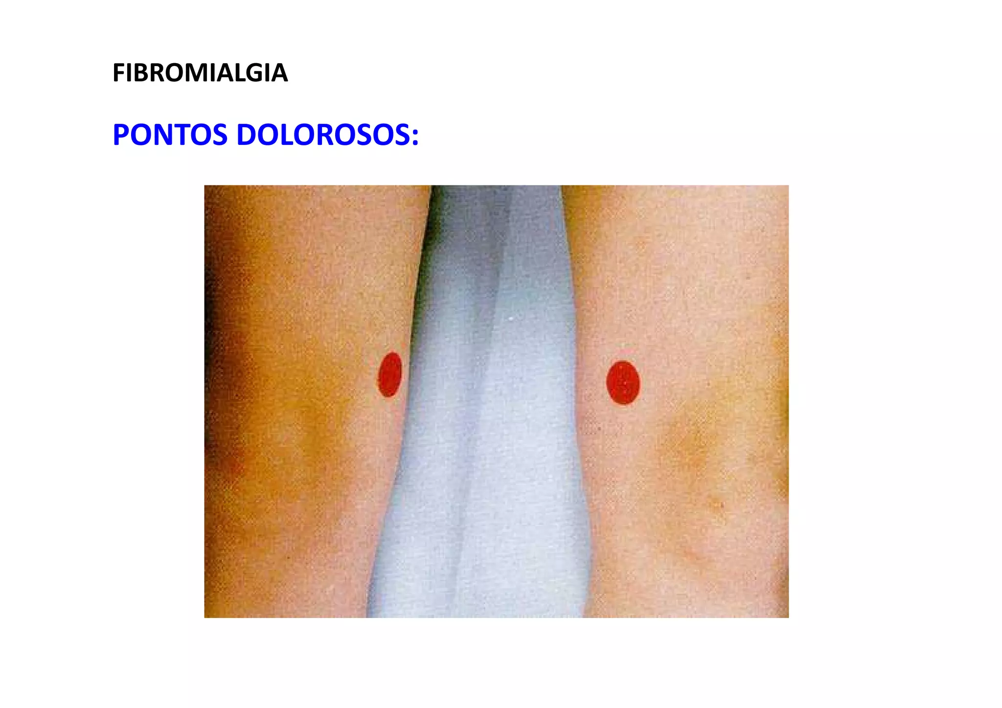 FIBROMIALGIA
PONTOS DOLOROSOS:
 