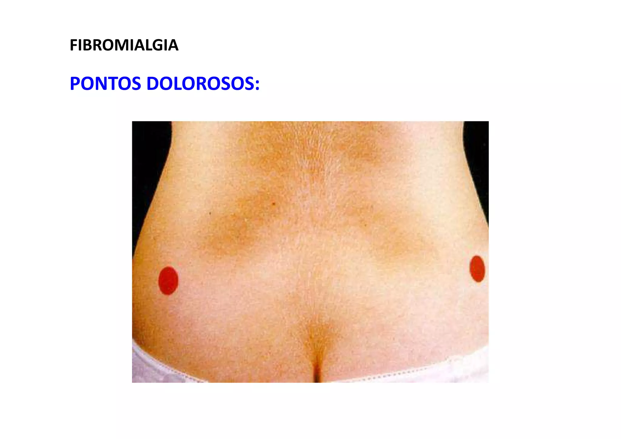 FIBROMIALGIA
PONTOS DOLOROSOS:
 