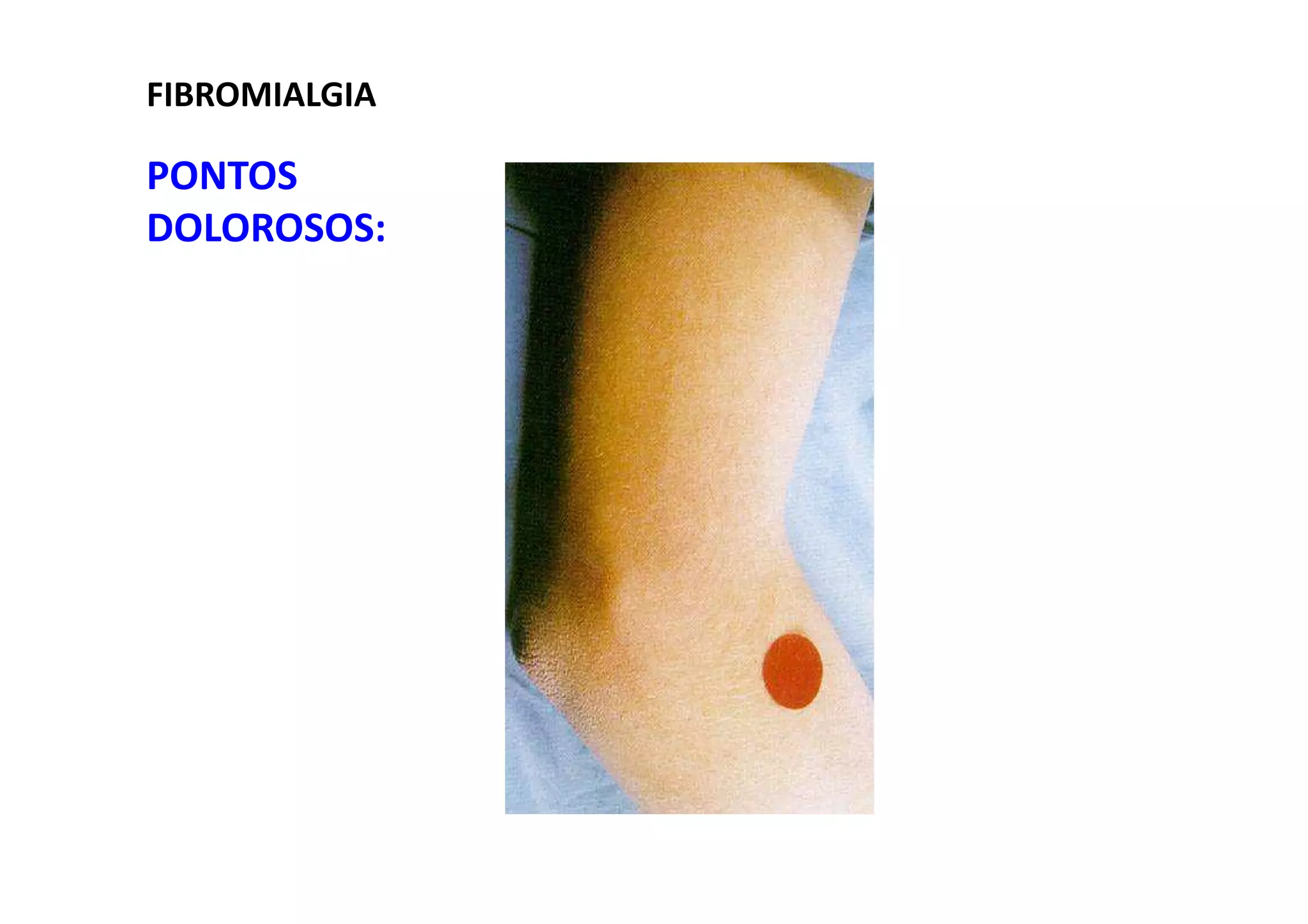 FIBROMIALGIA
PONTOS
DOLOROSOS:
 