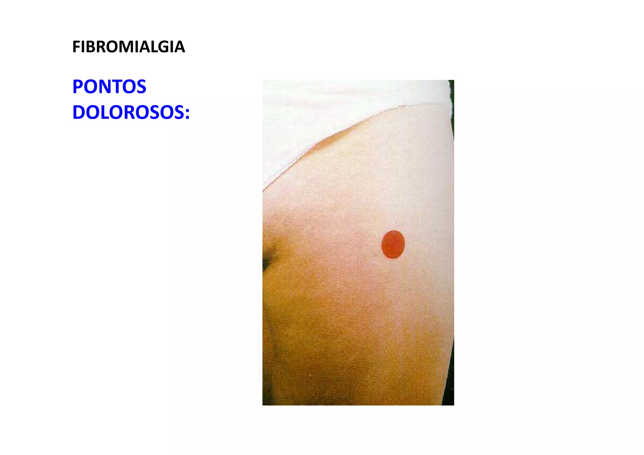 FIBROMIALGIA
PONTOS
DOLOROSOS:
 
