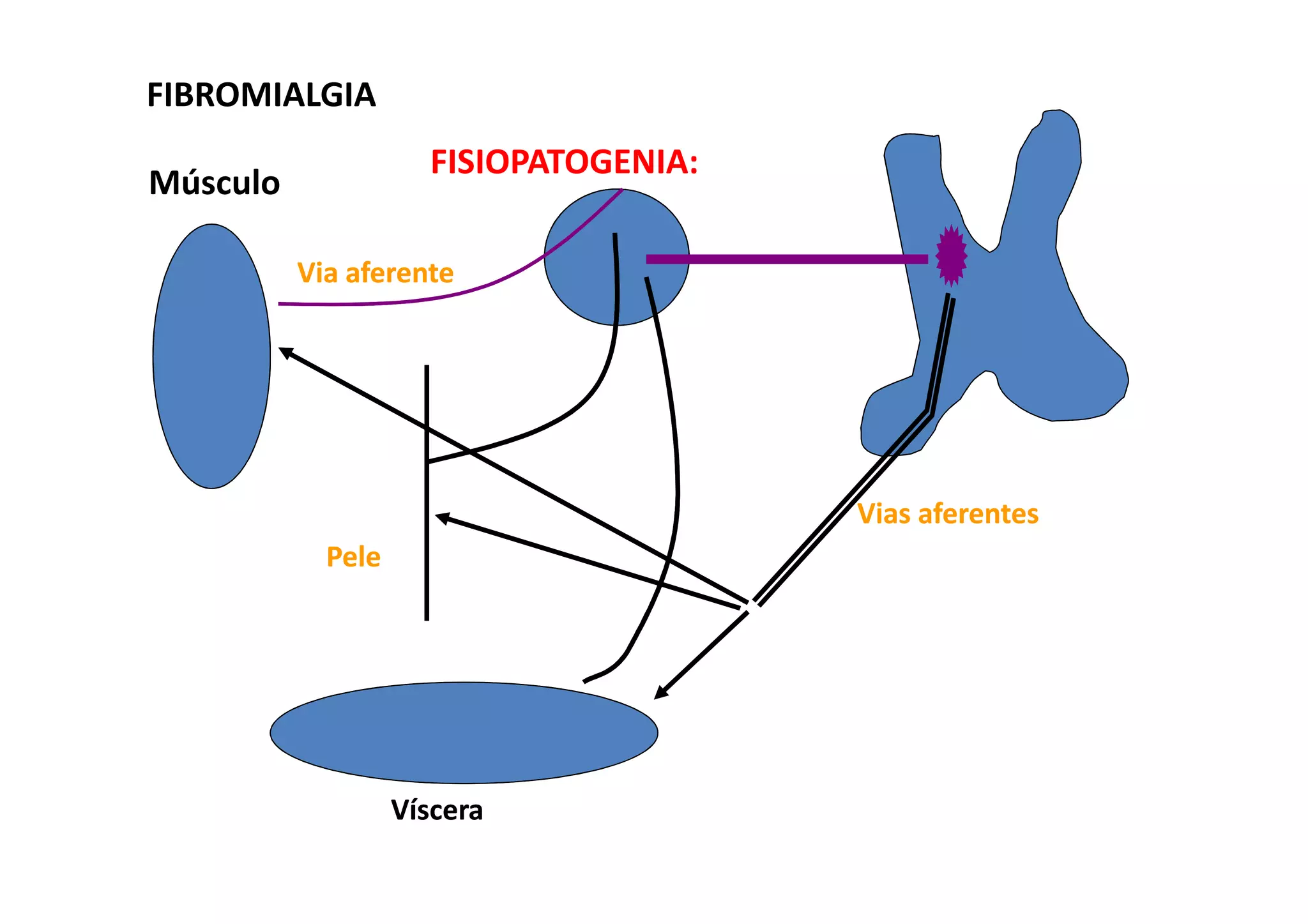 FIBROMIALGIA
PelePele
Músculo
VísceraVíscera
Vias aferentesVias aferentes
Via aferenteVia aferente
FISIOPATOGENIA:
 