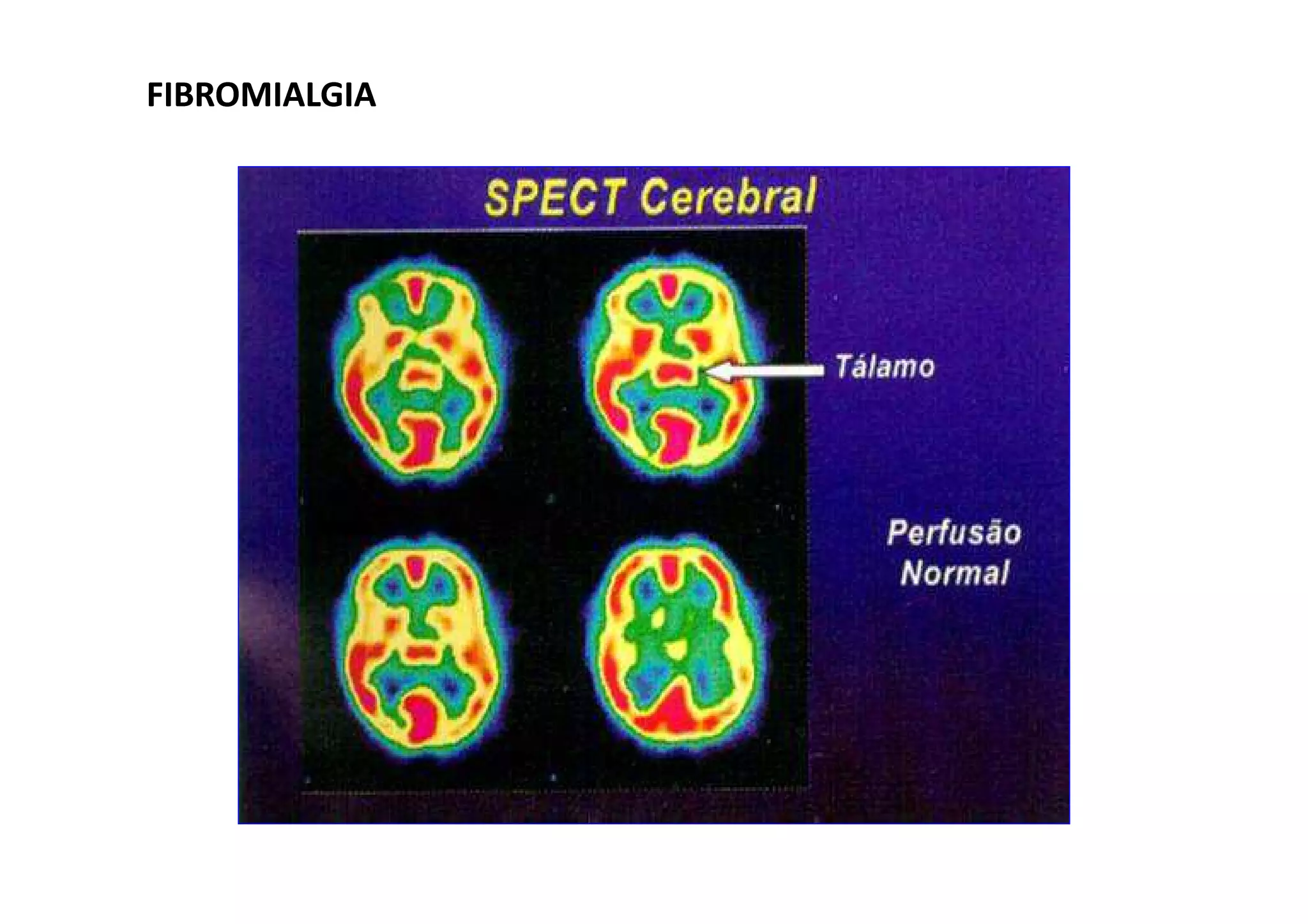 FIBROMIALGIAFIBROMIALGIA
 