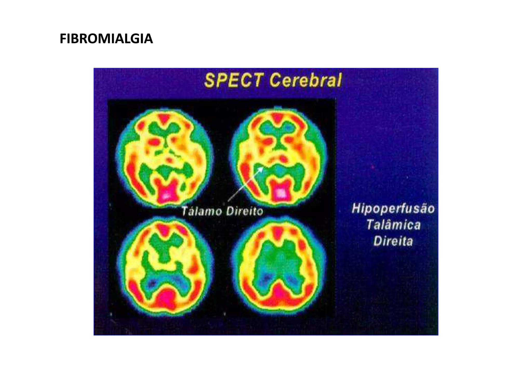 FIBROMIALGIAFIBROMIALGIA
 