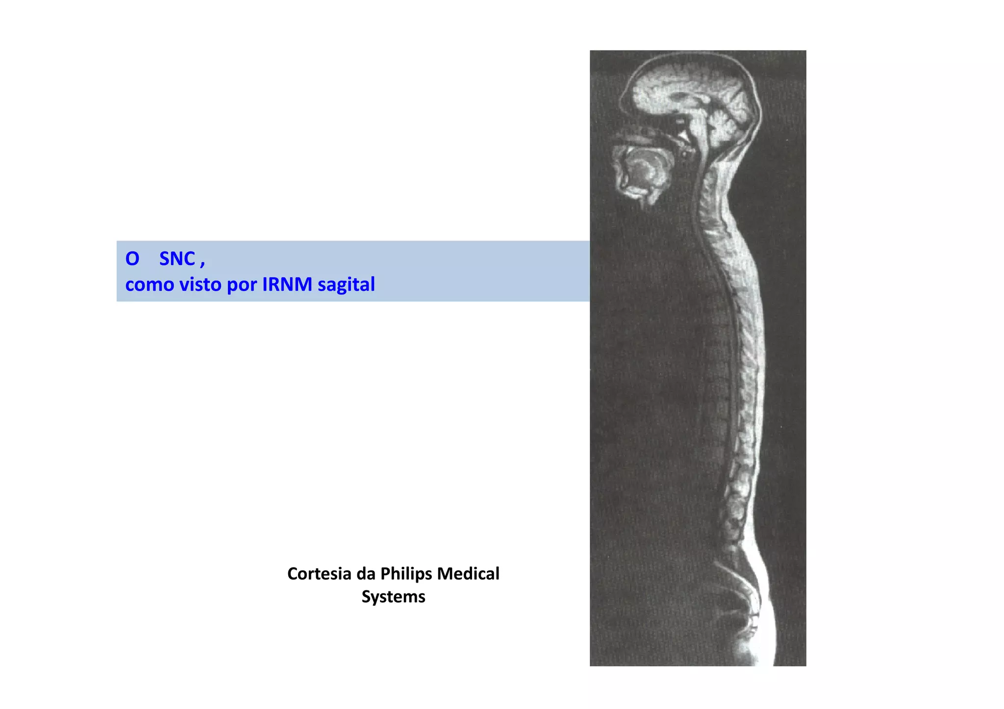 O SNC ,
como visto por IRNM sagital
Cortesia da Philips Medical
Systems
 