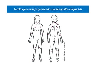 Localizações mais frequentes dos pontos-gatilho miofasciais
 