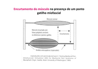 Encurtamento do músculo na presença de um ponto
gatilho miofascial
 