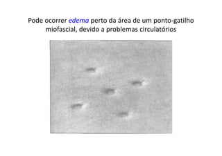 Pode ocorrer edema perto da área de um ponto-gatilho
miofascial, devido a problemas circulatórios
 