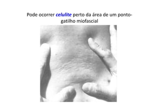 Pode ocorrer celulite perto da área de um ponto-
gatilho miofascial
 