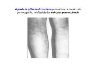 A perda de pêlos do dermátomo pode ocorrer em casos de
pontos-gatilho miofasciais dos músculos para-espinhais
 
