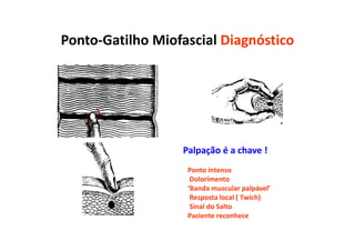 Ponto-Gatilho Miofascial Diagnóstico
Palpação é a chave !
Ponto intenso
Dolorimento
‘Banda muscular palpável’
Resposta local ( Twich)
Sinal do Salto
Paciente reconhece
 
