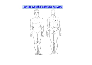 Pontos Gatilho comuns na SDM
 