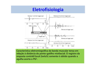 Eletrofisiologia
Característica eletromiográfica da banda muscular tensa em
relação à distância do ponto-gatilho miofascial. O registro da
resposta contrátil local (twitch) somente é obtido quando a
agulha acerta o PG1.
 