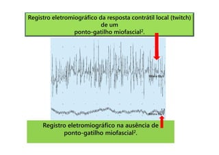 Registro eletromiográfico da resposta contrátil local (twitch)
de um
ponto-gatilho miofascial2.
Registro eletromiográfico na ausência de
ponto-gatilho miofascial2.
 