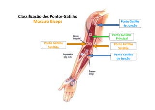 Ponto Gatilho
Principal
Ponto Gatilho
Satélite
Ponto Gatilho
Satélite
Ponto Gatilho
de Junção
Ponto Gatilho
de Junção
Classificação dos Pontos-Gatilho
Músculo Bíceps
 