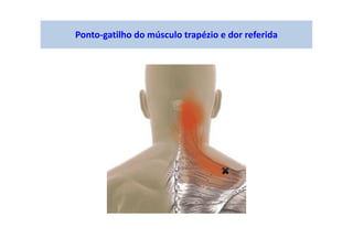 Ponto-gatilho do músculo trapézio e dor referida
 