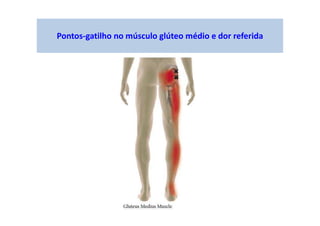Pontos-gatilho no músculo glúteo médio e dor referida
 