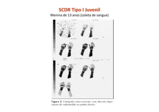SCDR Tipo I Juvenil
Menina de 13 anos (coleta de sangue)
 