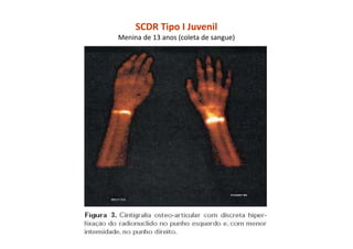 SCDR Tipo I Juvenil
Menina de 13 anos (coleta de sangue)
 