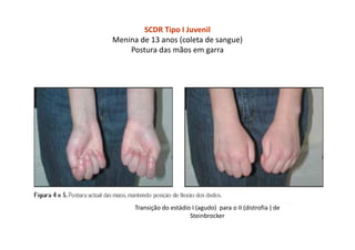 SCDR Tipo I Juvenil
Menina de 13 anos (coleta de sangue)
Postura das mãos em garra
Transição do estádio I (agudo) para o II (distrofia ) de
Steinbrocker
 